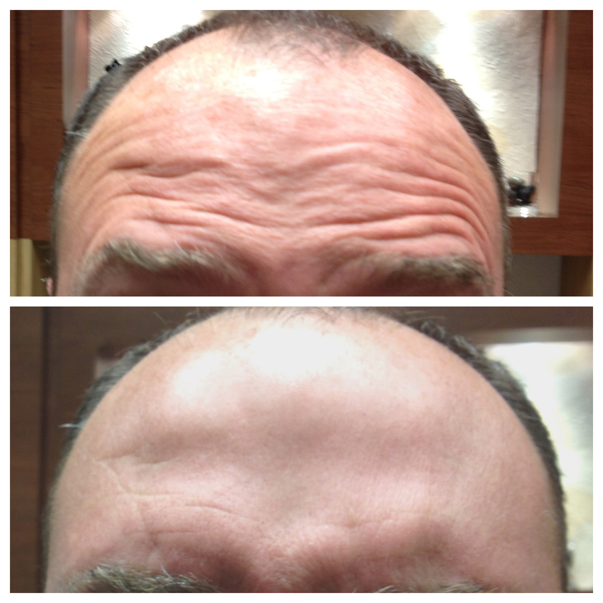 Before and after men's aesthetic treatment to forehead and hair restoration