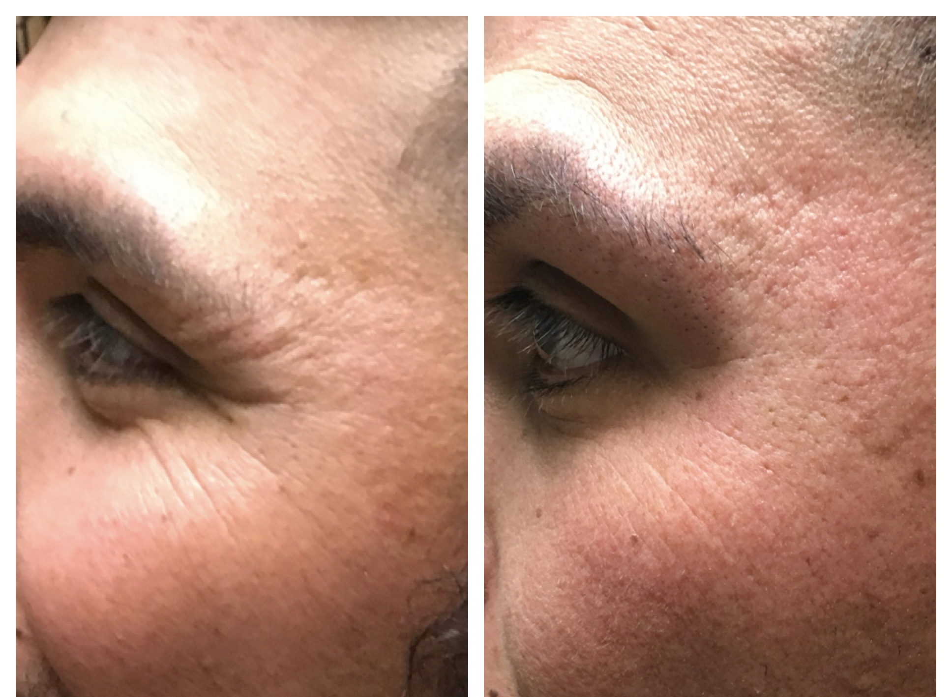 Before and after of men's aesthetic treatments side view of face and eyes