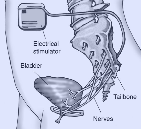 Sacral Neuromodulation