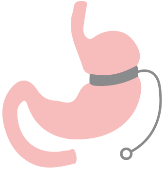 Laparoscopic Adjustable Band