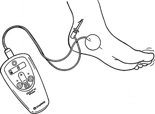 Percutaneous Tibial Nerve Stimulation
