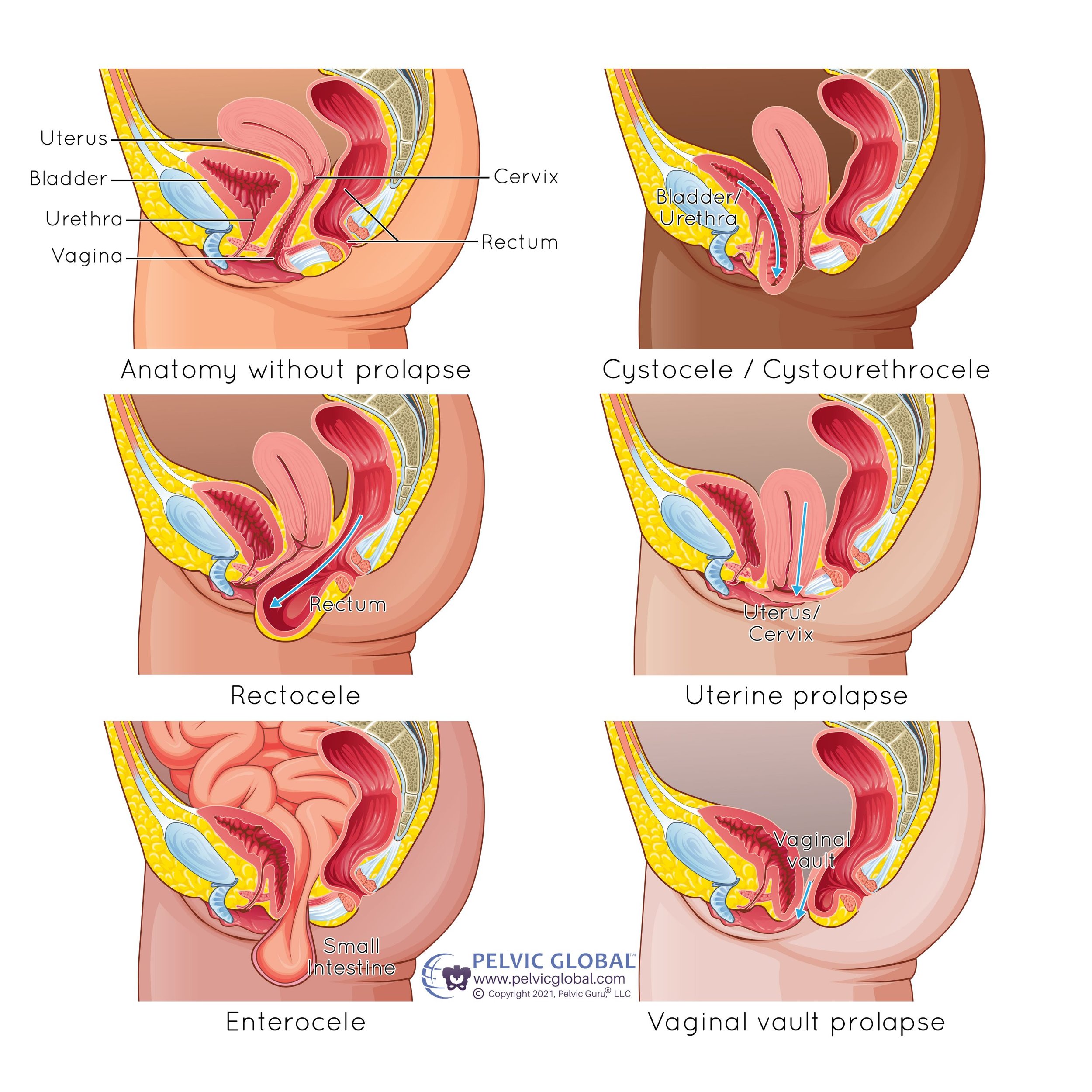 Female Prolapse