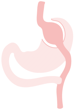 Roux-en-Y Gastric Bypass