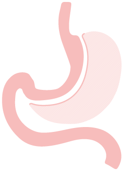 Sleeve Gastrectomy