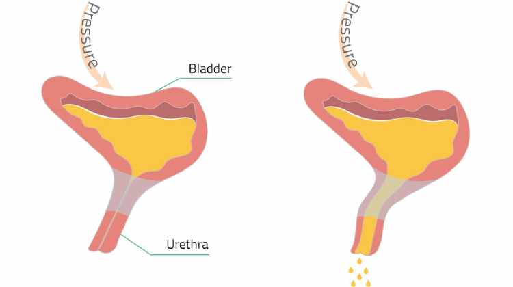 Stress Urinary Incontinence